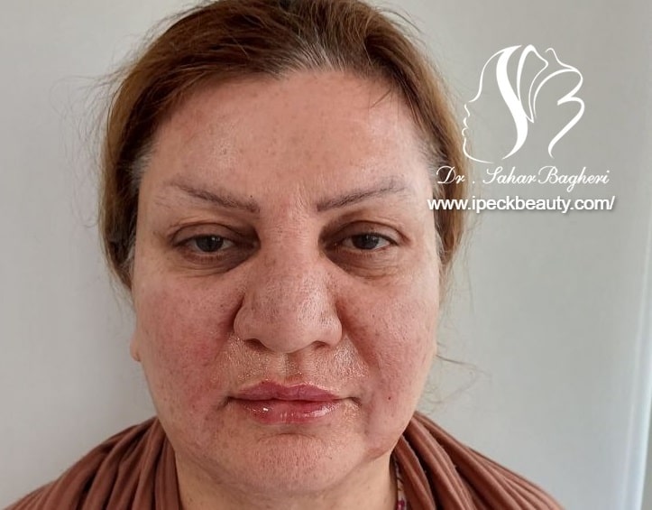 تزریق ژل لب