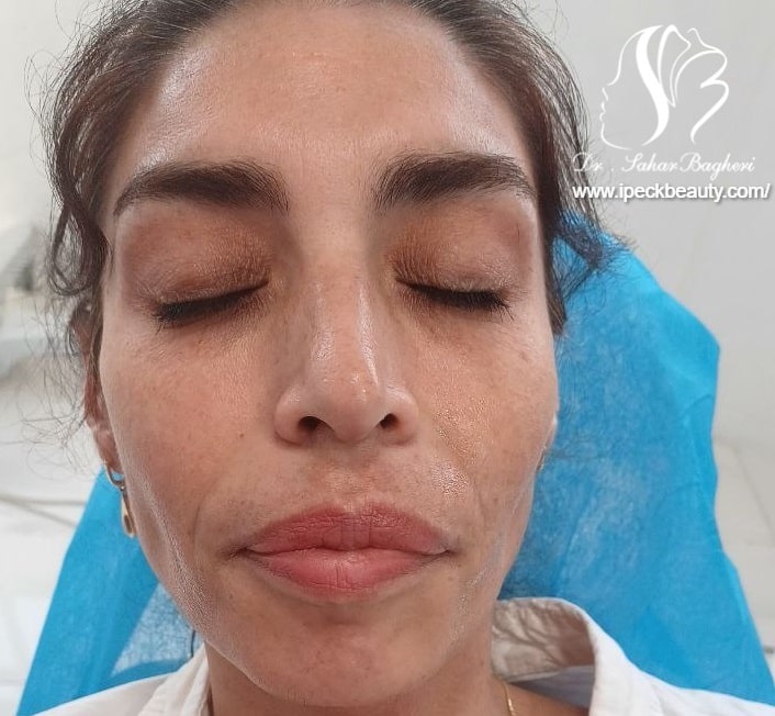 تزریق فیلر خط خنده