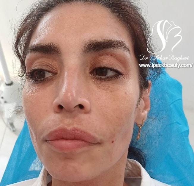 تزریق فیلر خط خنده