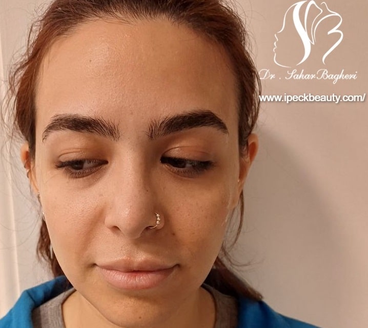 تزریق ژل لب