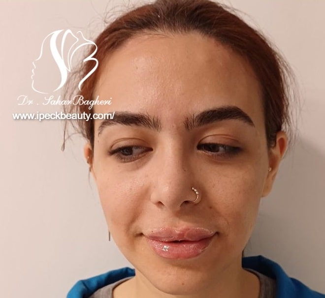 تزریق ژل لب