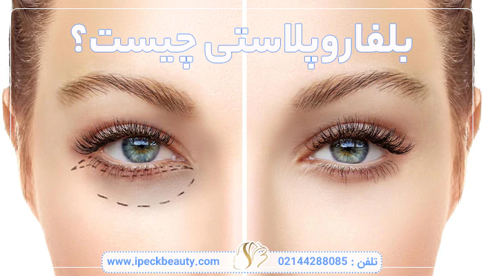 بلفاروپلاستی چیست؟