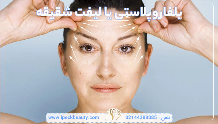 بلفاروپلاستی یا لیفت شقیقه