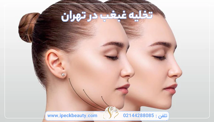 تخلیه غبغب در تهران