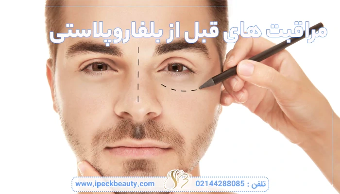 مراقبت های قبل از بلفاروپلاستی چیست؟