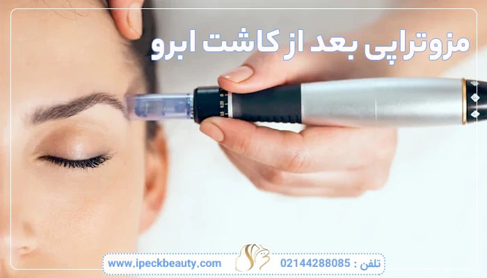مزوتراپی بعد از کاشت ابرو
