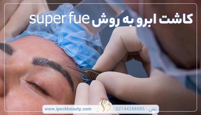 کاشت ابرو به روش SUPER FUE