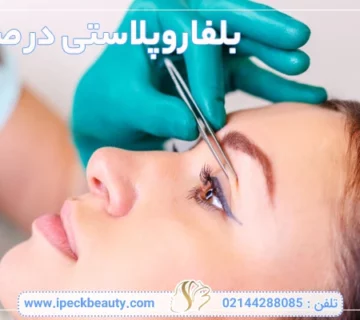 بلفاروپلاستی در صادقیه