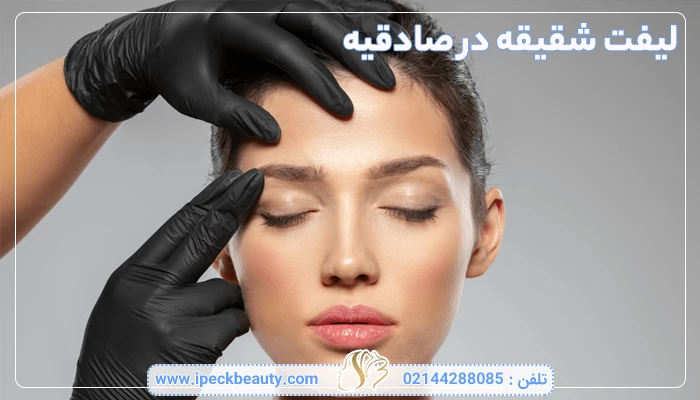 لیفت شقیقه در صادقیه