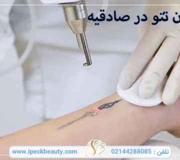 پاک کردن تتو در صادقیه