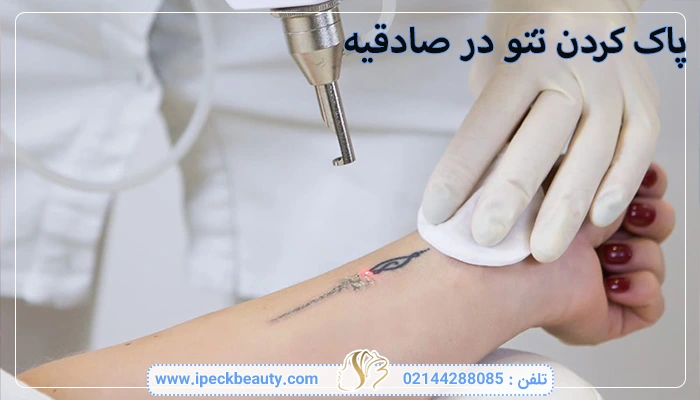 پاک کردن تتو در صادقیه