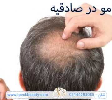 کاشت مو در صادقیه